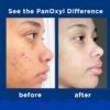 PanOxyl Acne Foaming Wash Benzoyl Peroxide 10% Maximum Strength Antimicrobial