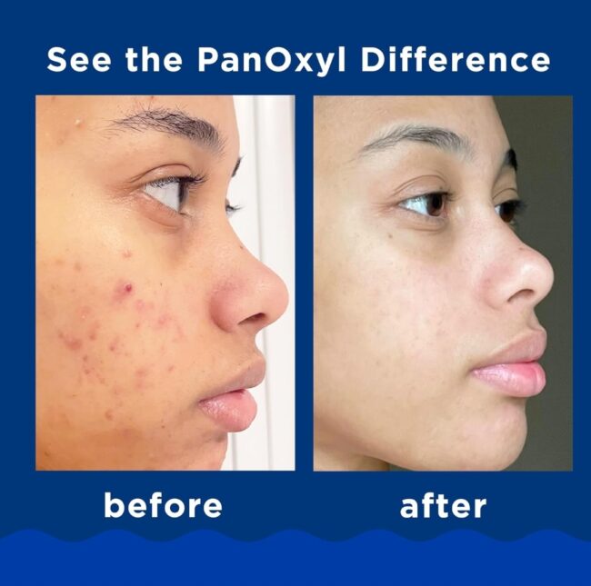 PanOxyl Acne Foaming Wash Benzoyl Peroxide 10% Maximum Strength Antimicrobial